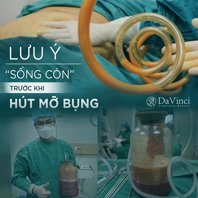 Hút mỡ và các biến chứng nguy hiểm thường gặp khi phẫu thuật