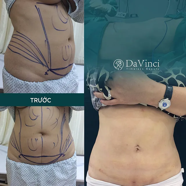 Hút mỡ và các biến chứng nguy hiểm thường gặp khi phẫu thuật