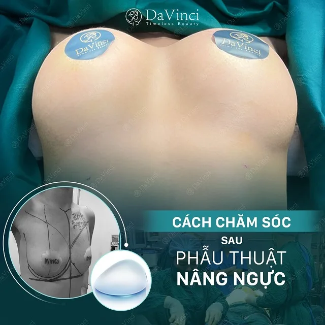 Túi nâng ngực có độ bền và khả năng chịu lực thế nào? Túi nâng ngực có độ bền và khả năng chịu lực thế nào?
