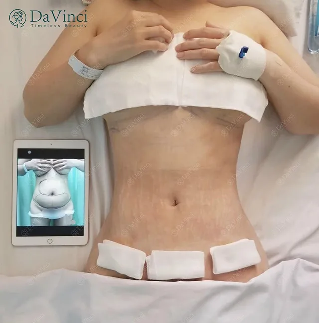 Những lưu ý sau khi hút mỡ bụng để an toàn và không biến chứng