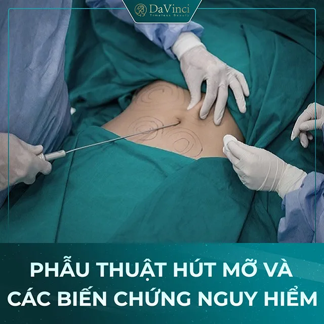 Những lưu ý sau khi hút mỡ bụng để an toàn và không biến chứng