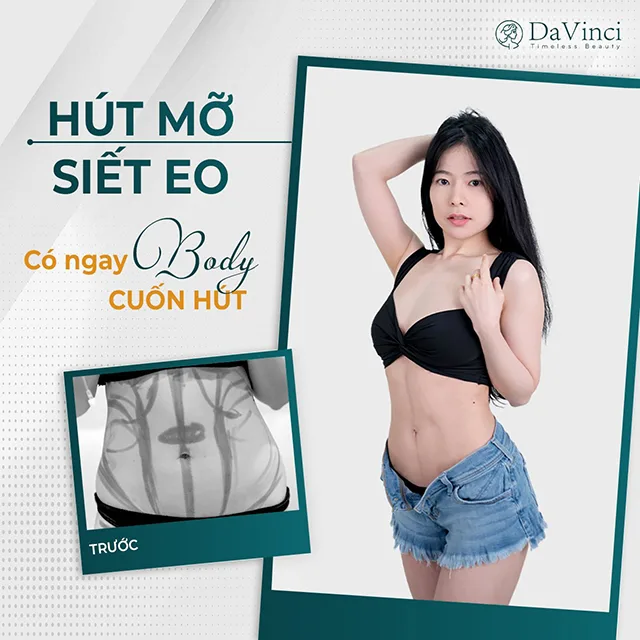 Hút mỡ bụng không phẫu thuật là gì? Hút mỡ bụng có an toàn không?
