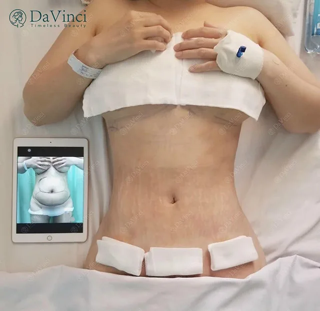 Hút mỡ bụng có đau không? 5 Cách giảm đau cực nhanh sau hút mỡ bụng?