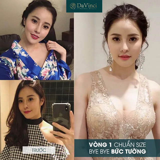 Nâng ngực bằng mỡ tự thân là gì? Review nâng ngực bằng mỡ tự thân