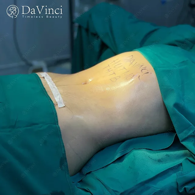 Quy trình hút mỡ bụng diễn ra như thế nào?
