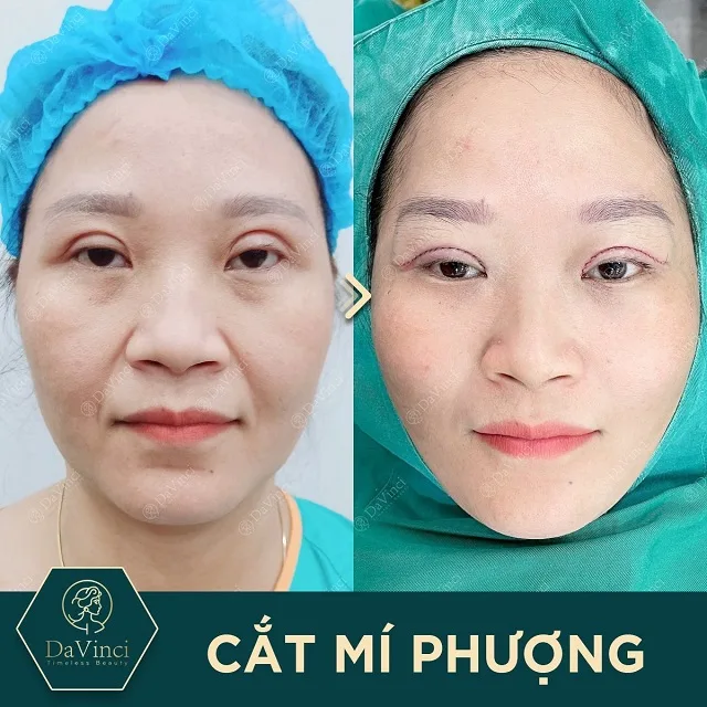 Chỉnh sửa mí lỗi hỏng, trợn sâu sau phẫu thuật đẹp tự nhiên an toàn