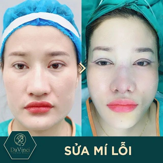 Chỉnh sửa mí lỗi hỏng, trợn sâu sau phẫu thuật đẹp tự nhiên an toàn