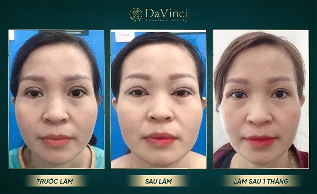Chỉnh sửa mí lỗi hỏng, trợn sâu sau phẫu thuật đẹp tự nhiên an toàn