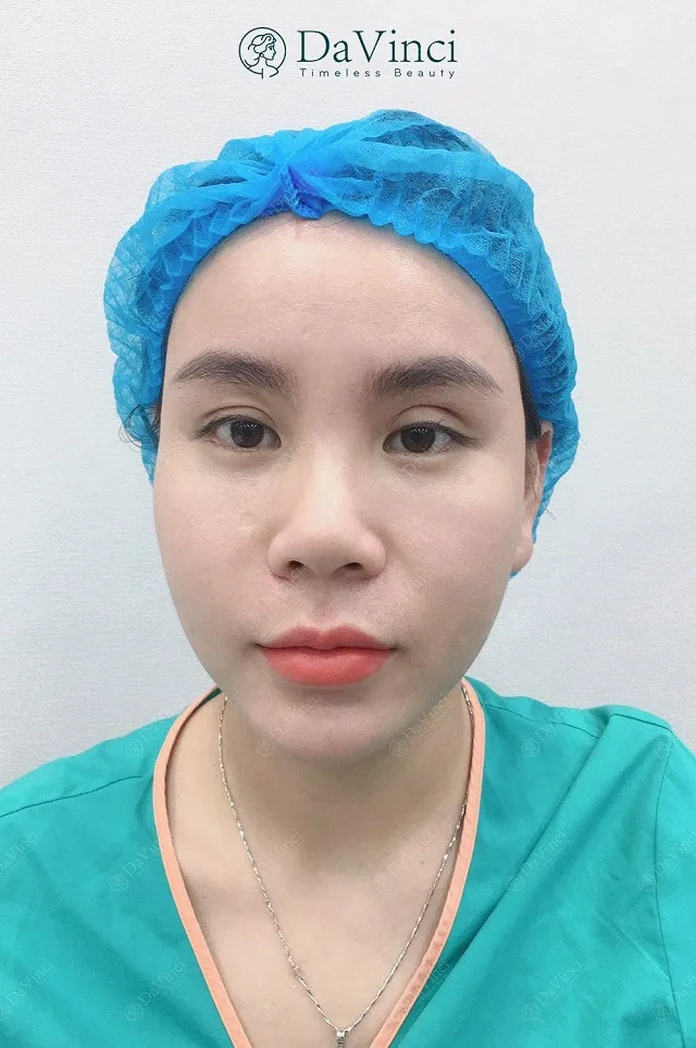 Chỉnh sửa mí lỗi hỏng, trợn sâu sau phẫu thuật đẹp tự nhiên an toàn