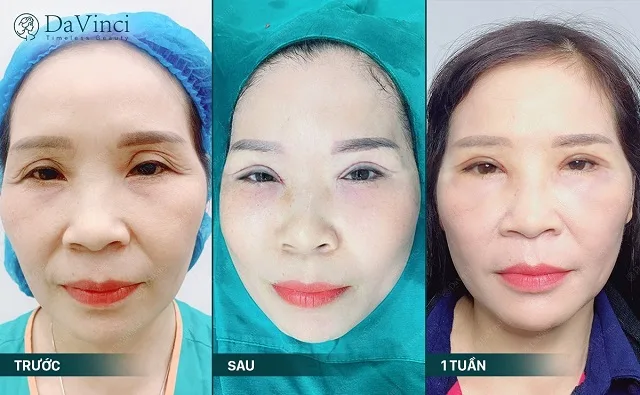 Chỉnh sửa mí lỗi hỏng, trợn sâu sau phẫu thuật đẹp tự nhiên an toàn