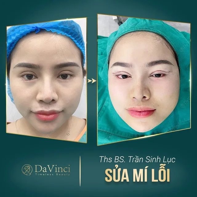 Chỉnh sửa mí lỗi hỏng, trợn sâu sau phẫu thuật đẹp tự nhiên an toàn