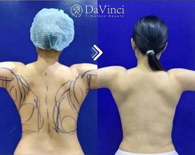Hút mỡ lưng ở đâu tốt đẹp tự nhiên? Hút mỡ lưng giá bao nhiêu?