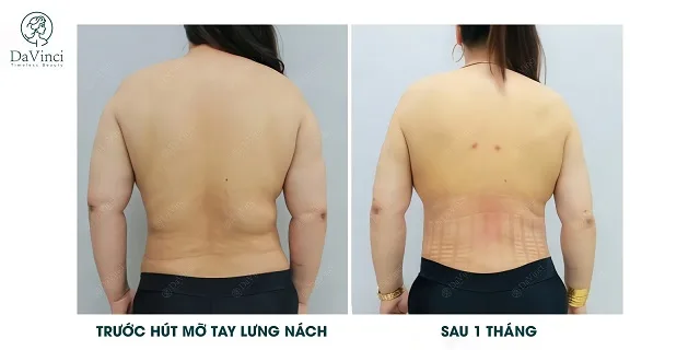Hút mỡ lưng ở đâu tốt đẹp tự nhiên? Hút mỡ lưng giá bao nhiêu?