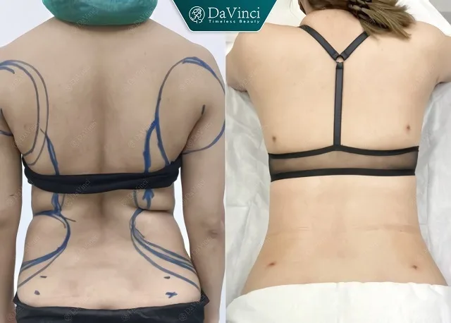 Hút mỡ lưng ở đâu tốt đẹp tự nhiên? Hút mỡ lưng giá bao nhiêu?