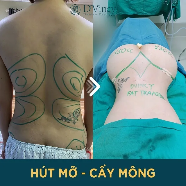 Hút mỡ lưng ở đâu tốt đẹp tự nhiên? Hút mỡ lưng giá bao nhiêu?