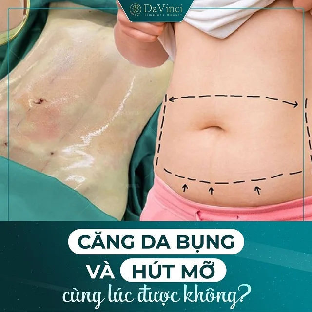 Căng da bụng toàn phần giá bao nhiêu ? Bao lâu thì hồi phục Căng da bụng toàn phần giá bao nhiêu ? Bao lâu thì hồi phục