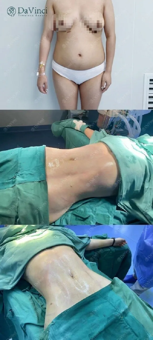Căng da bụng toàn phần giá bao nhiêu ? Bao lâu thì hồi phục