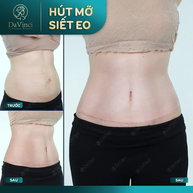 Căng da bụng toàn phần giá bao nhiêu ? Bao lâu thì hồi phục Căng da bụng toàn phần giá bao nhiêu ? Bao lâu thì hồi phục