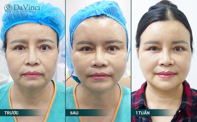 Căng da mặt tầng giữa giúp trẻ hóa làn da phục hồi thanh xuân Căng da mặt tầng giữa giúp trẻ hóa làn da phục hồi thanh xuân