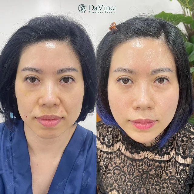Căng da mặt tầng giữa giúp trẻ hóa làn da phục hồi thanh xuân Căng da mặt tầng giữa giúp trẻ hóa làn da phục hồi thanh xuân