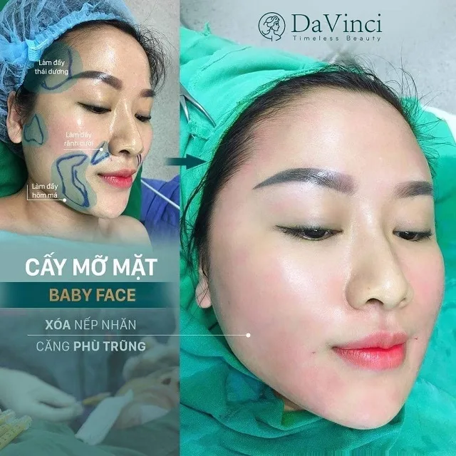 Cấy mỡ Baby Face giúp trẻ hóa nĩu giữ thanh xuân trên gương mặt