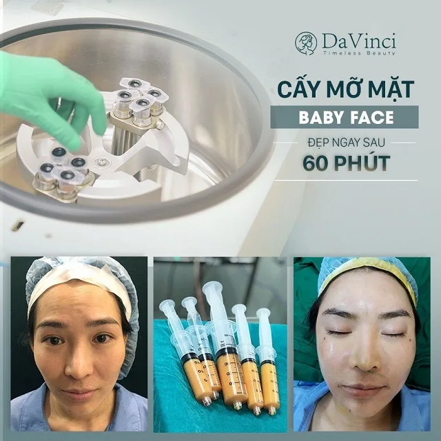 Cấy mỡ Baby Face giúp trẻ hóa nĩu giữ thanh xuân trên gương mặt