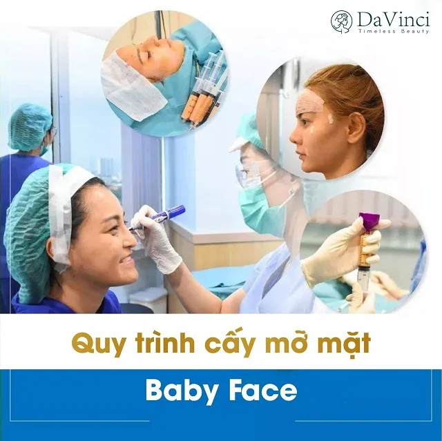 Cấy mỡ Baby Face giúp trẻ hóa nĩu giữ thanh xuân trên gương mặt