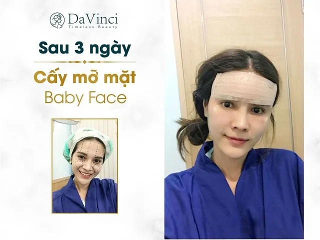 Cấy mỡ Baby Face giúp trẻ hóa nĩu giữ thanh xuân trên gương mặt