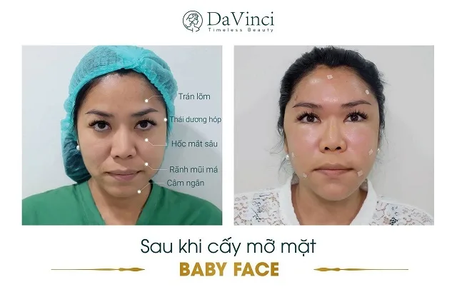 Cấy mỡ Baby Face giúp trẻ hóa nĩu giữ thanh xuân trên gương mặt