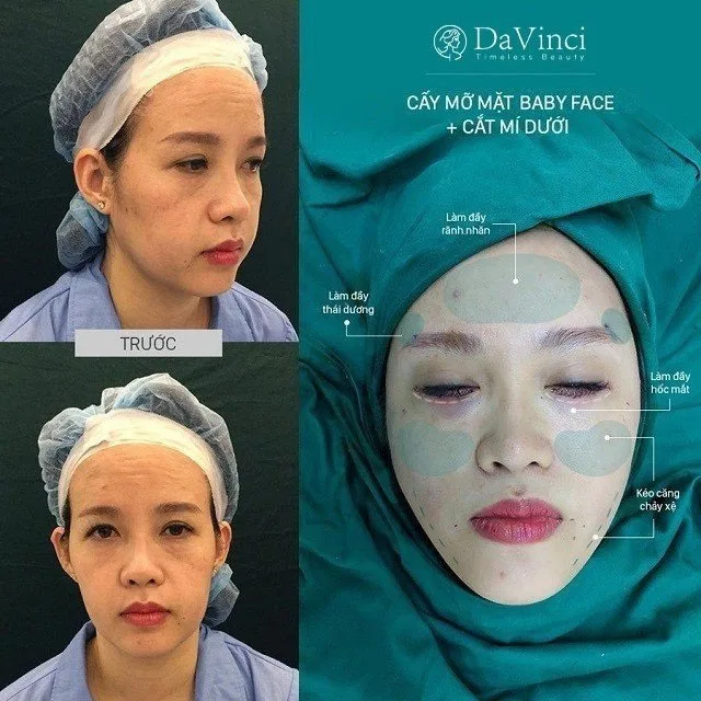 Cấy mỡ Baby Face giúp trẻ hóa nĩu giữ thanh xuân trên gương mặt