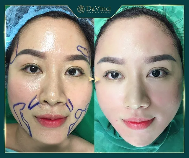 Cấy mỡ má giá bao nhiêu? Duy trì được bao lâu? Có tốt và an toàn không