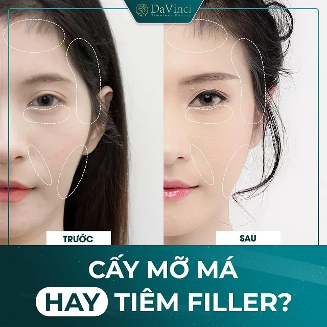 Cấy mỡ má giá bao nhiêu? Duy trì được bao lâu? Có tốt và an toàn không