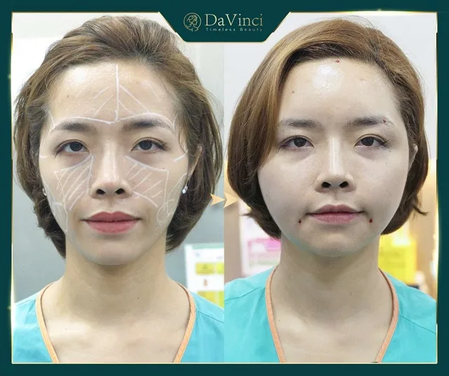 Cấy mỡ má giá bao nhiêu? Duy trì được bao lâu? Có tốt và an toàn không
