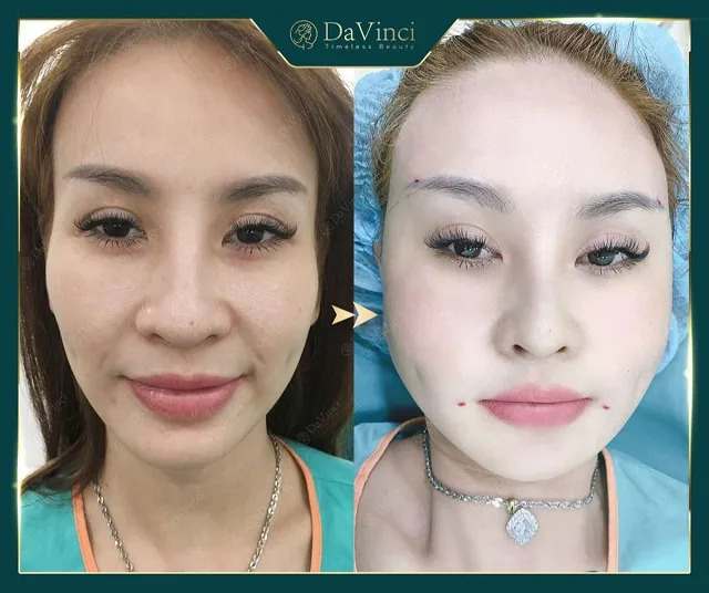 Cấy mỡ má giá bao nhiêu? Duy trì được bao lâu? Có tốt và an toàn không