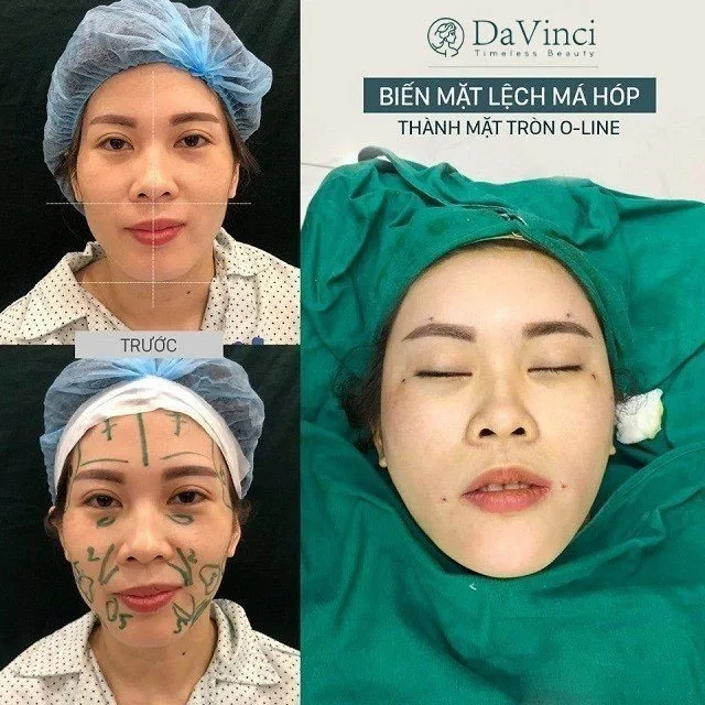Cấy mỡ má giá bao nhiêu? Duy trì được bao lâu? Có tốt và an toàn không