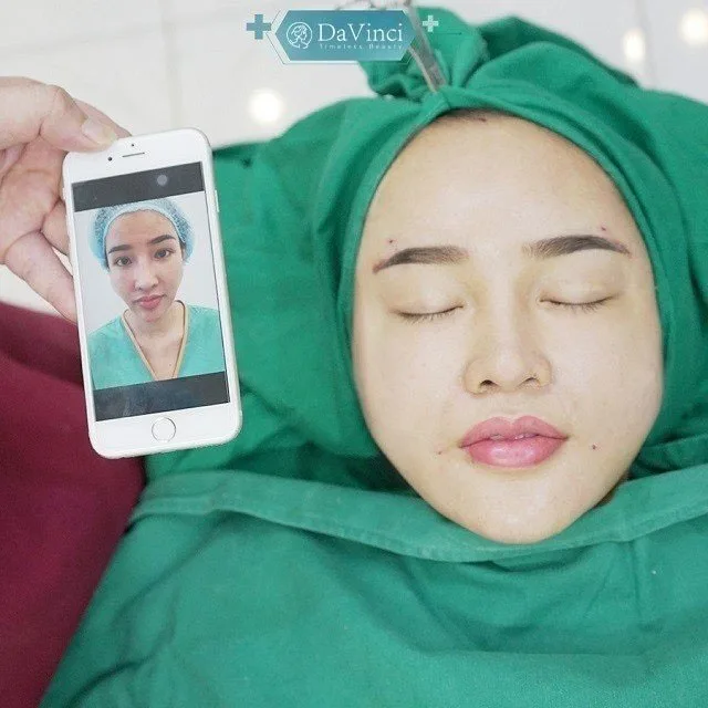 Cấy mỡ má giá bao nhiêu? Duy trì được bao lâu? Có tốt và an toàn không