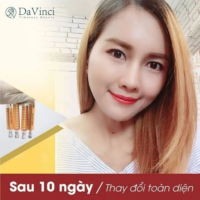 Cấy mỡ má giá bao nhiêu? Duy trì được bao lâu? Có tốt và an toàn không