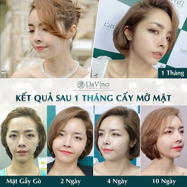Cấy mỡ mặt duy trì được bao lâu? Giá bao nhiêu? Bao lâu thì đẹp? 