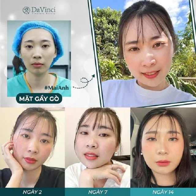 Cấy mỡ mặt duy trì được bao lâu? Giá bao nhiêu? Bao lâu thì đẹp? 