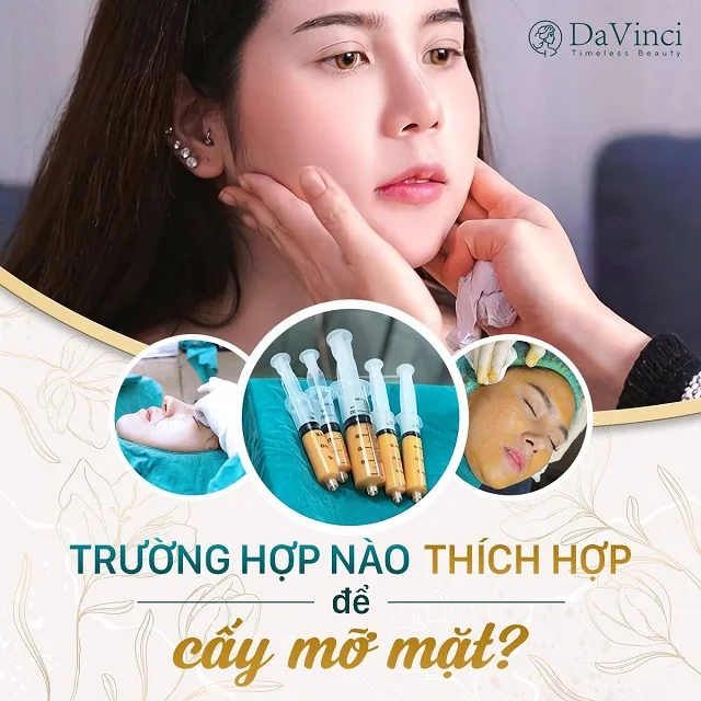 Cấy mỡ mặt duy trì được bao lâu? Giá bao nhiêu? Bao lâu thì đẹp? 