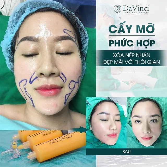 Cấy mỡ mặt duy trì được bao lâu? Giá bao nhiêu? Bao lâu thì đẹp? 