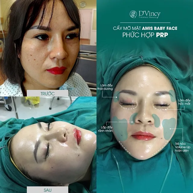 Cấy mỡ trẻ hoá mắt giá bao nhiêu? Cấy mỡ trẻ hoá mắt có an toàn không? Cấy mỡ trẻ hoá mắt giá bao nhiêu? Cấy mỡ trẻ hoá mắt có an toàn không?
