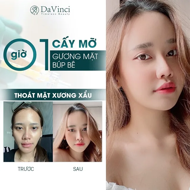 Cấy mỡ mặt duy trì được bao lâu? Giá bao nhiêu? Bao lâu thì đẹp? 