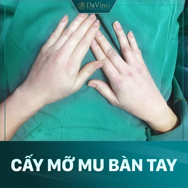 Cấy mỡ mu bàn tay giá bao nhiêu? Ở đâu an toàn uy tín ? Cấy mỡ mu bàn tay giá bao nhiêu? Ở đâu an toàn uy tín ?