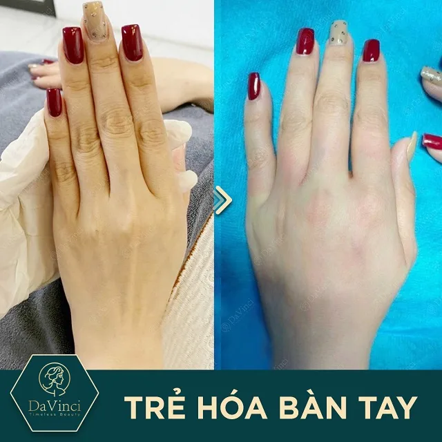 Cấy mỡ mu bàn tay giá bao nhiêu? Ở đâu an toàn uy tín ? Cấy mỡ mu bàn tay giá bao nhiêu? Ở đâu an toàn uy tín ?