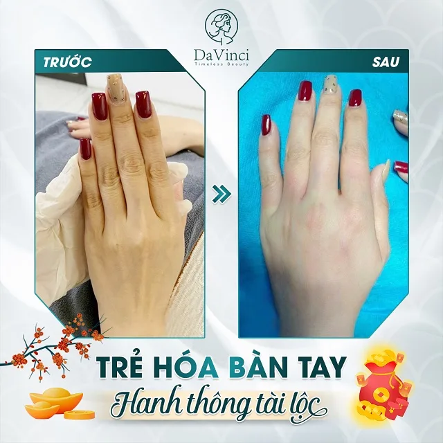 Cấy mỡ mu bàn tay giá bao nhiêu? Ở đâu an toàn uy tín ? Cấy mỡ mu bàn tay giá bao nhiêu? Ở đâu an toàn uy tín ?