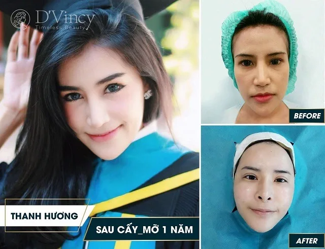 Cấy mỡ thái dương giá bao nhiêu? Có đau và nguy hiểm không? 