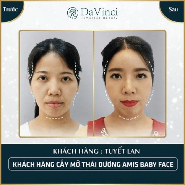Cấy mỡ thái dương giá bao nhiêu? Có đau và nguy hiểm không? 
