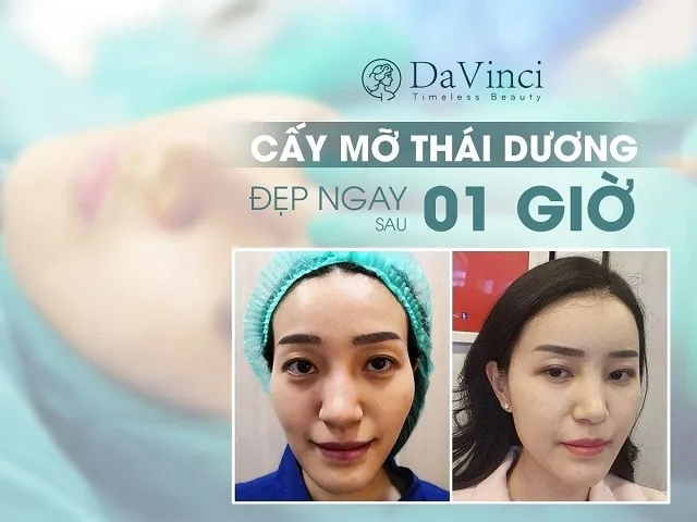 Cấy mỡ thái dương giá bao nhiêu? Có đau và nguy hiểm không? 