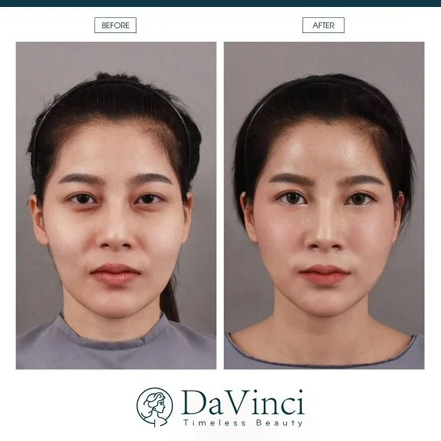 Cấy mỡ thái dương giá bao nhiêu? Có đau và nguy hiểm không? 